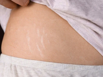 8 Penyebab Stretch Mark di Kulit dan Cara Menghilangkannya