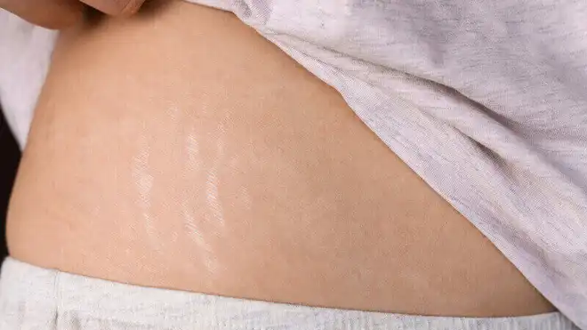 8 Penyebab Stretch Mark di Kulit dan Cara Menghilangkannya