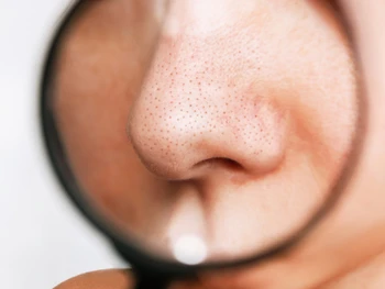 7 Cara Menghilangkan Komedo di Hidung dan Penyebabnya