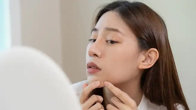 Apakah Begadang Menyebabkan Jerawat? Yuk Cari Tahu Jawabannya!