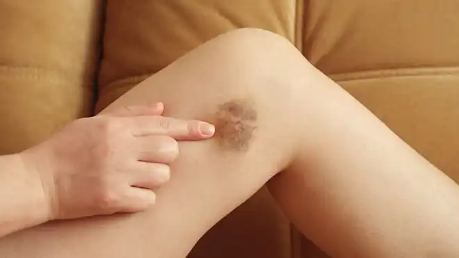 10 Cara Menghilangkan Bekas Luka di Kaki yang Lama & Menghitam